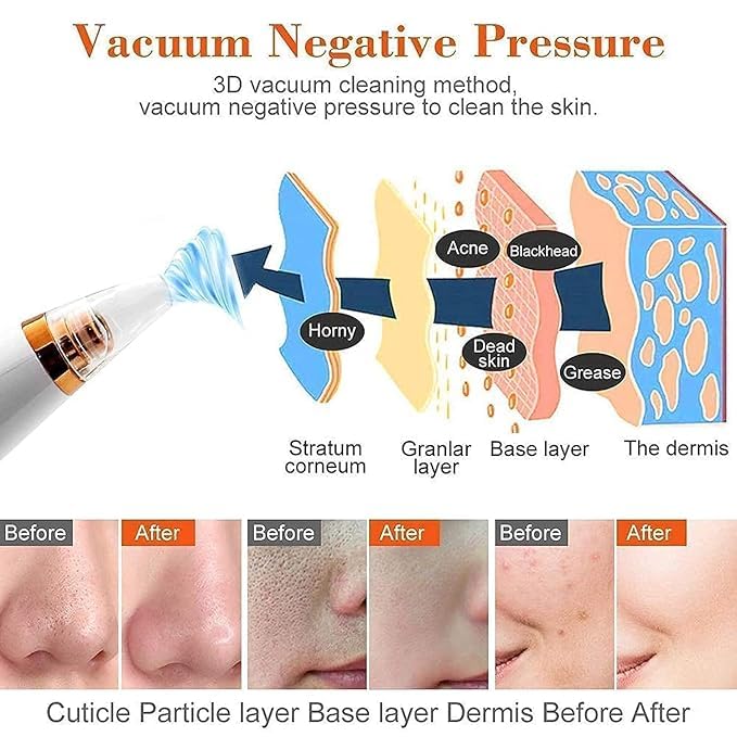 DermaGlow™ 6 In 1 Derma Suction blackhead remover machine