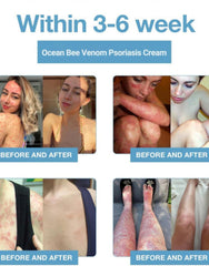 Bee Venom &Ocean Psoriasis Healing Cream ( Pack Of 2 )
