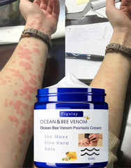 Bee Venom &Ocean Psoriasis Healing Cream ( Pack Of 2 )